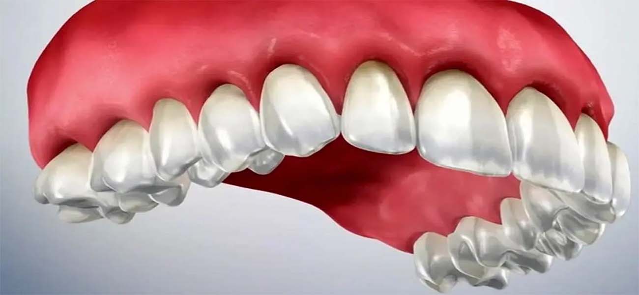 جراحی لثه چیست و چه زمانی لازم است؟