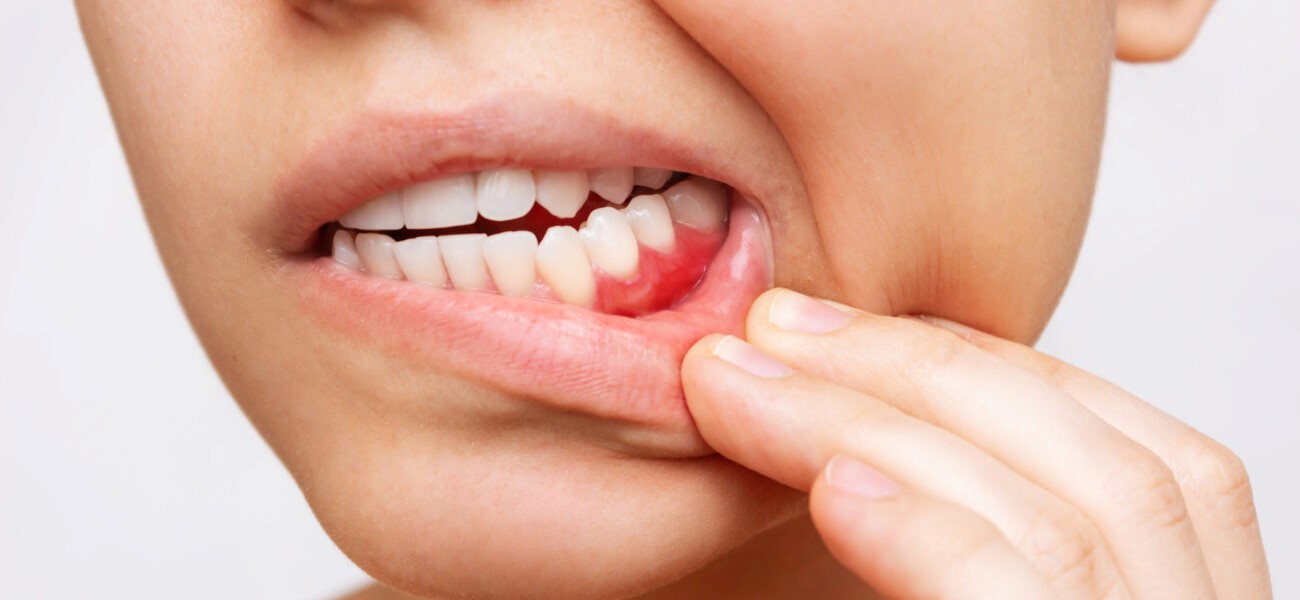 تفاوت بین جراحی لثه و پیوند لثه چیست؟
