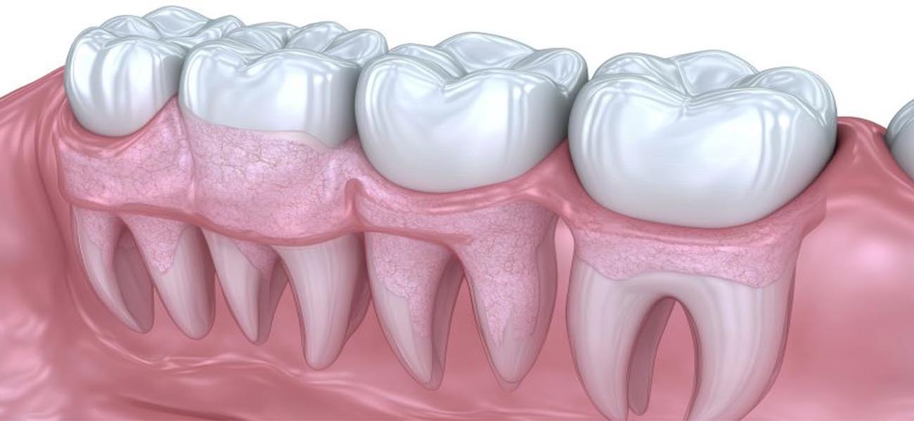 جراحی لثه چیست و چه زمانی لازم است؟