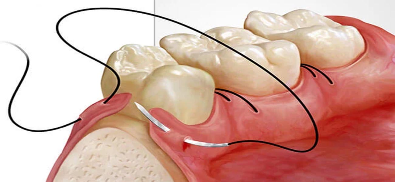 جراحی لثه چیست و چه زمانی لازم است؟